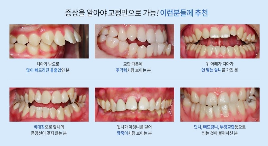 청소년치아교정 예민한 시기에 딱맞는 치료 여기서 찾자 관련 이미지 6