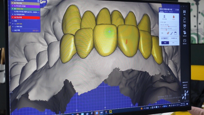 What to Check Before Deciding on Dental Laminates image 5
