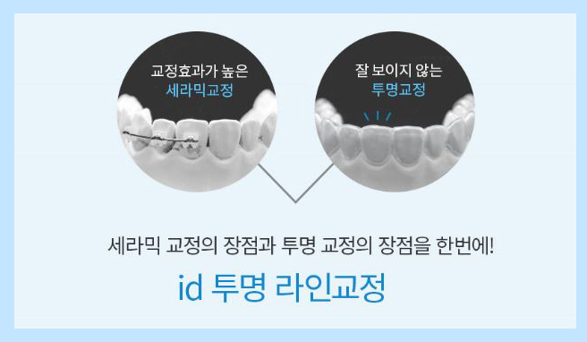 투명교정 부작용 해결을 도와줄 id 투명라인교정 관련 이미지 3