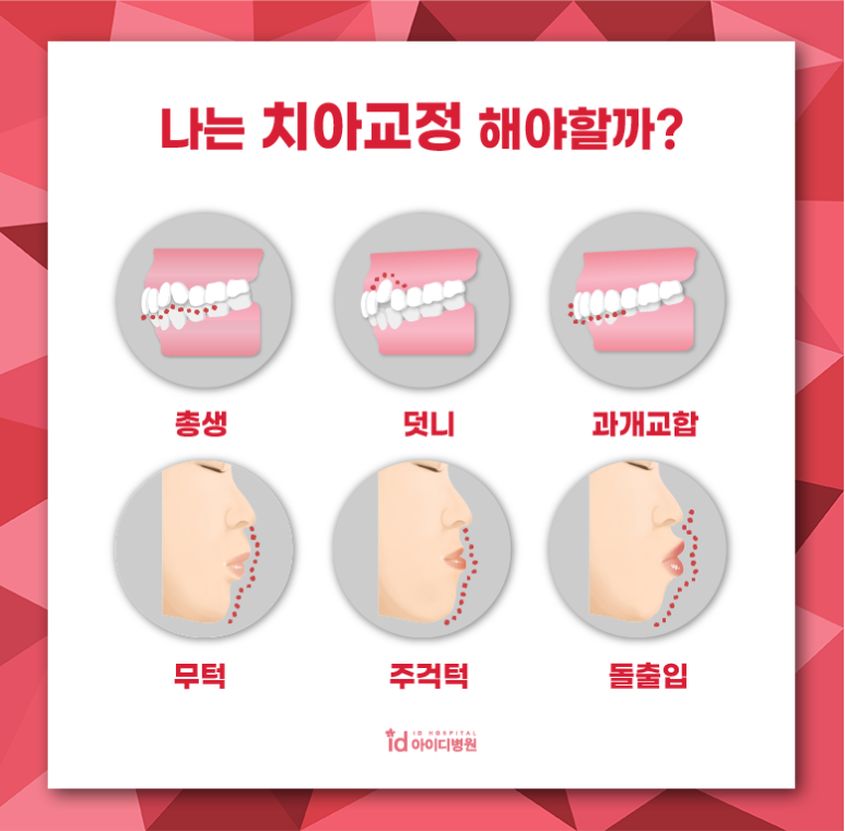 치아교정이 필요한 원인과 경우 관련 이미지 2