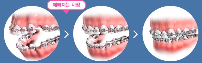 돌출입교정 어디까지 알고 있나요? 관련 이미지 7