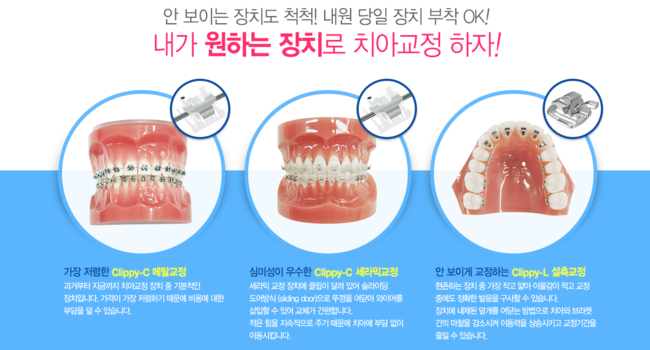 돌출입, 수술없이 치아교정으로 해결 관련 이미지 4