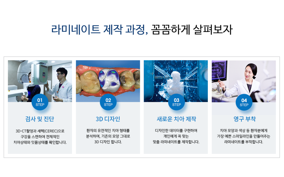 라미네이트, 시술 전 체크해야 할 것은? 관련 이미지 5