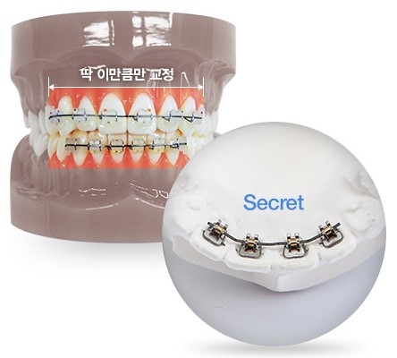 치아교정, 가지런한 치아배열을 위한 선택 관련 이미지 6