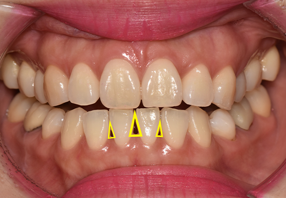 Gum Filler: When the Empty Space Between Teeth Becomes a Concern image 2