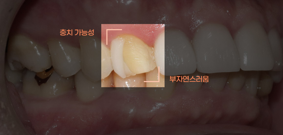 라미네이트 치료를 위한 정보 관련 이미지 22