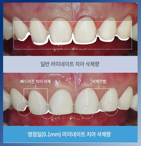 영점일 라미네이트 비용 만큼 중요한건 치아 삭제량! 관련 이미지 6