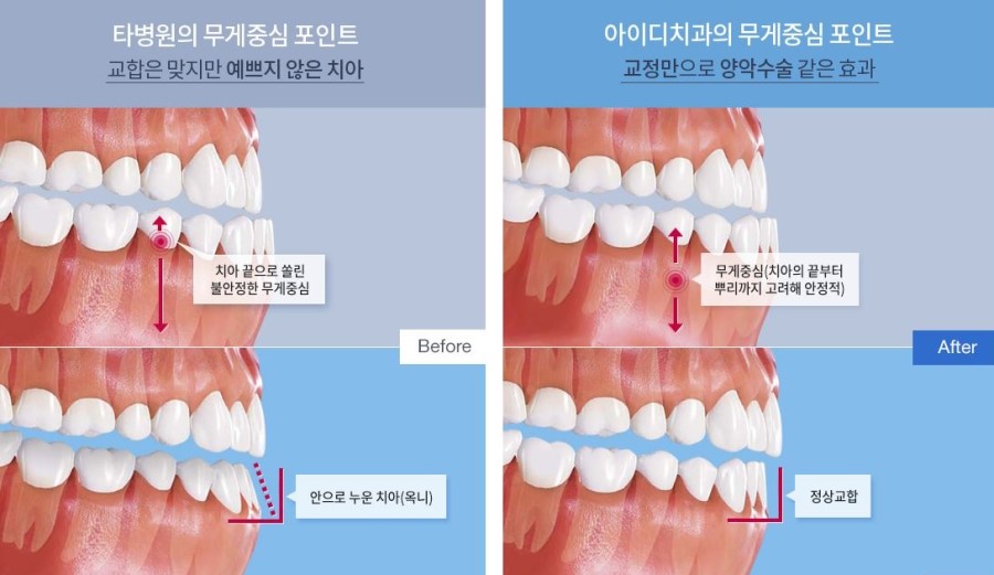 돌출입교정가격 입툭튀라고 수술하란법 없지! 관련 이미지 4