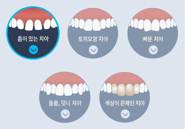 무삭제라미네이트 치아속까지 생각한다면 0.1이지 관련 이미지 3