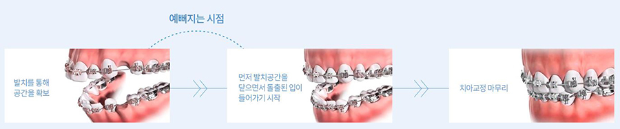 잠실교정치과 예쁜 입매 개선 이곳에서! 관련 이미지 3
