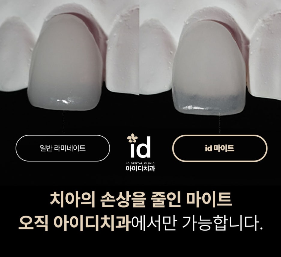 What to Check Before Deciding on Dental Laminates image 3