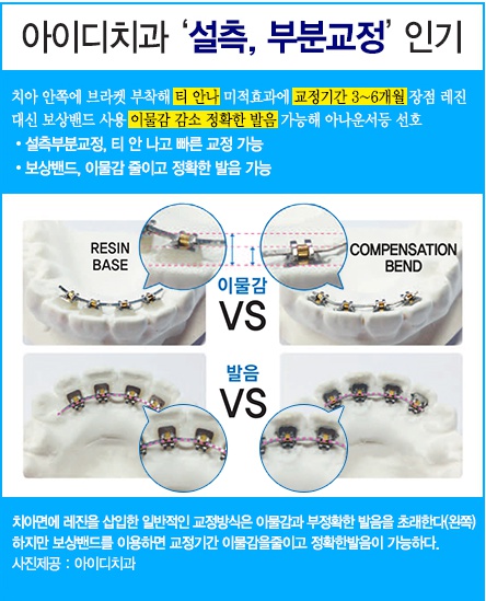 앞니설측교정 발음문제 해결, 심미적인 치아교정 관련 이미지 3