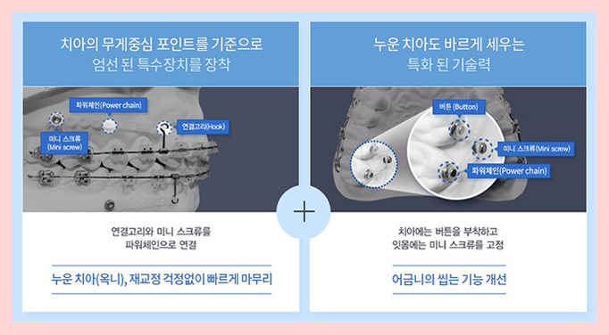 돌출입교정가격 무조건 넣는게 정답은 아니지 관련 이미지 4