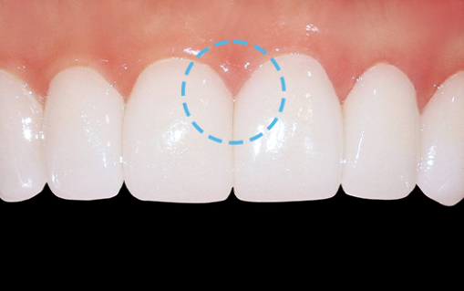 Gum Filler: When the Empty Space Between Teeth Becomes a Concern image 8