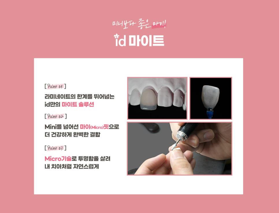 라미네이트 치료 전 알아두면 좋은 점 관련 이미지 2