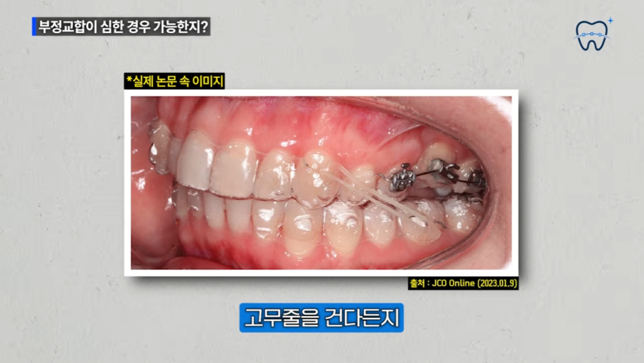 청담투명치아교정 인비절라인 잘하는곳 선택해야 하는 이유 관련 이미지 8