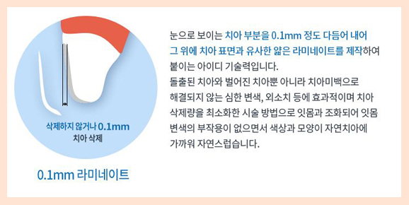 0.1mm 앞니 라미네이트 비용 자연치아 살리면서 튼튼하게 관련 이미지 3