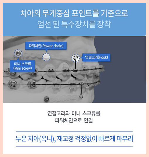 돌출입치아교정비용 찾아낸 반전매력 양악교정 믿을만해 관련 이미지 4