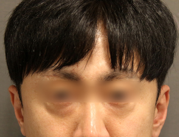 눈밑지방재배치와 하안검 수술이 어떻게 다른가요? 관련 이미지 2