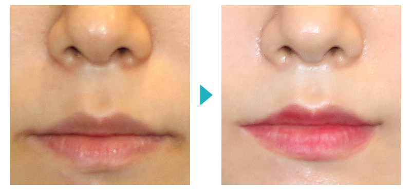 Surgery That Shortens the Midface Without Double Jaw Surgery: Philtrum Reduction Surgery image 4