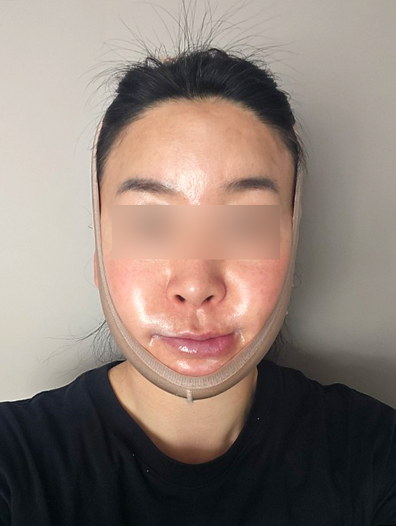 안면윤곽 수술 후 치아나 교합에 문제가 생길 수 있나요? 관련 이미지 2