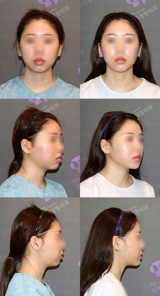 What Surgery Is Needed for a Long, Recessed Chin or a Short, Recessed Chin? image 8