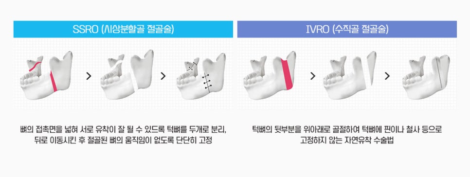 안면윤곽수술과 양악수술은 어떻게 다른가요? 관련 이미지 3