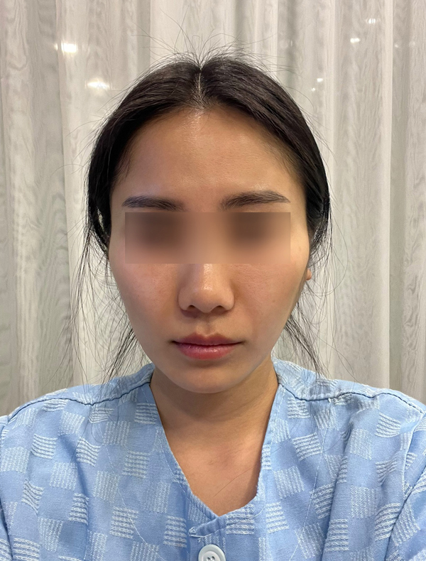 광대수술과 볼패임 교정을 같이 할 수 있나요? 관련 이미지 1