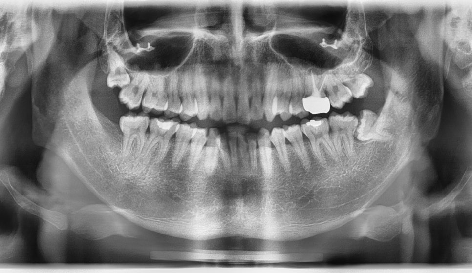 After Facial Contouring Surgery: Asymmetry, When Can Revision Surgery Be Performed? image 11