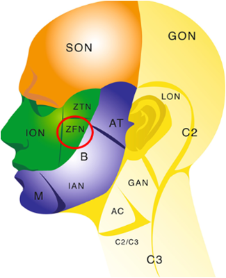 Cheek Sagging? Nonunion? Hollow Cheeks? A Complete Guide to 6 Side Effects of Zygoma Surgery image 11