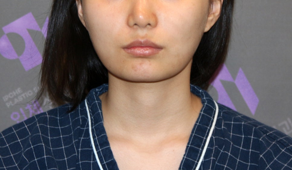 [Chin Surgery] Learning About Contouring Shaving and T-Osteotomy with Real Patient Cases (3) image 13