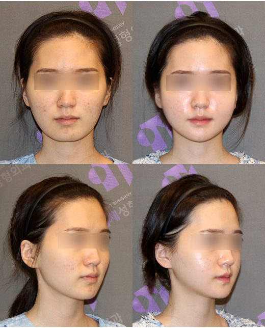 Anesthesia Accidents in Facial Contouring Surgery, Death Cases - Explained by a Plastic Surgery Specialist image 1