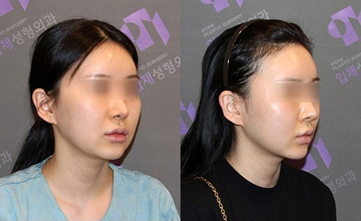 230도 입체 광대축소술로 재수술도 가능할까요? 관련 이미지 13