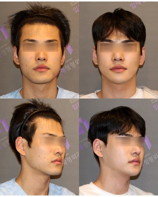 Facial Mimetic Muscle Anatomy for Botox Procedures image 3