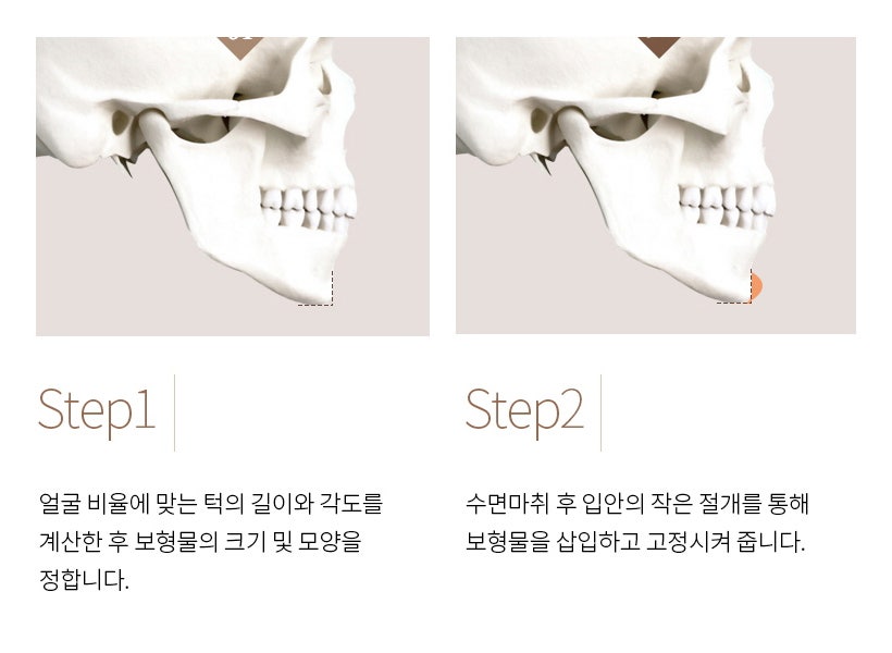 Chin Implants and Chin Advancement Surgery: Real Surgical Cases and What to Know image 2