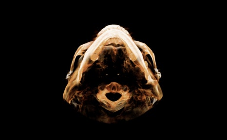 After cheekbone reduction surgery, is there still a back cheekbone left? Is there a solution? image 3