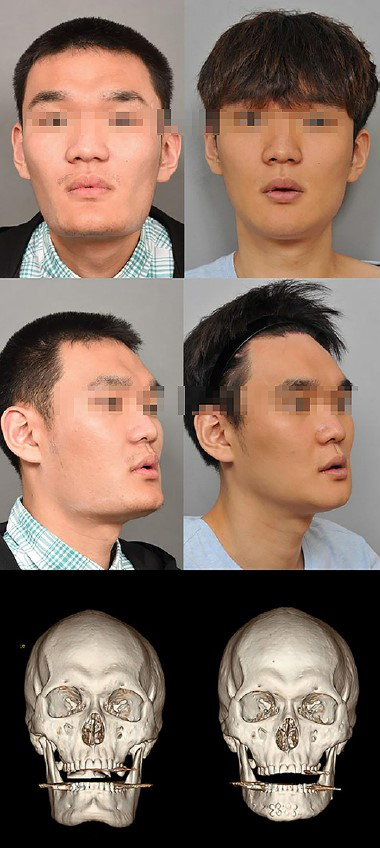 [논문 리뷰] 아시아인 안면윤곽수술에 대해서 관련 이미지 6