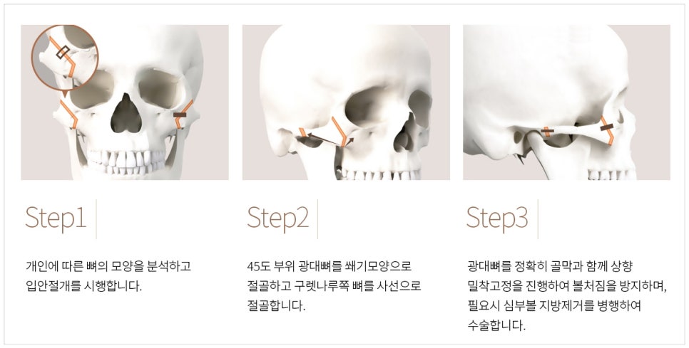 안면윤곽수술 50대에 받아도 될까요? 꼭 알아둬야 할 사항들 관련 이미지 8