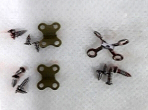 Would It Be Better to Use Absorbable Pins in Facial Contouring Surgery? About the Types, Advantages, and Disadvantages of Fixation Pins! image 2