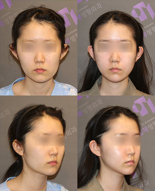 Side Effects of V-Line Square Jaw Surgery, Common Traits of People Who Experience Failed Results image 7