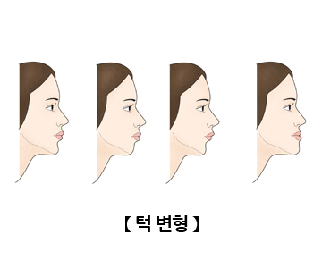 양악수술 후 부작용은 어떤 것이 있을까요? 관련 이미지 7