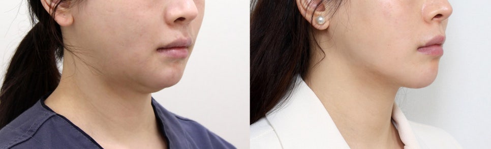 얼굴 작아지는 수술 & 시술 TOP 3 - 어떤 방법이 가장 효과적일까? 관련 이미지 4