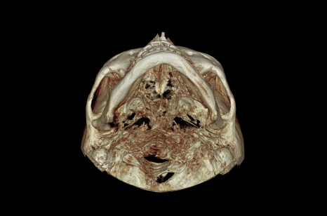 How Much Effect Does 230-Degree Zygoma Reduction Surgery Have? image 8