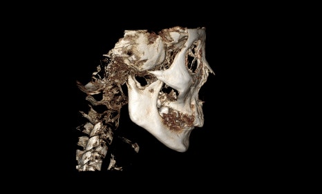 What Surgery Is Best for Correcting a Recessed Chin? The Limits of Chin Advancement Surgery and the Actual Results image 4