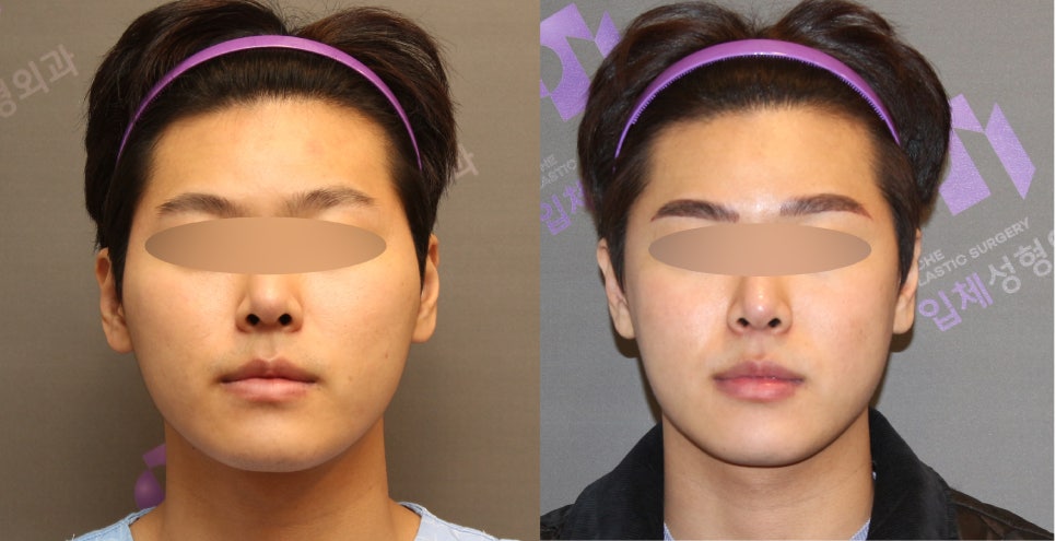 Male Cheekbone Reduction Surgery, Explained with Before-and-After Photos of Facial Contouring Surgery. image 4