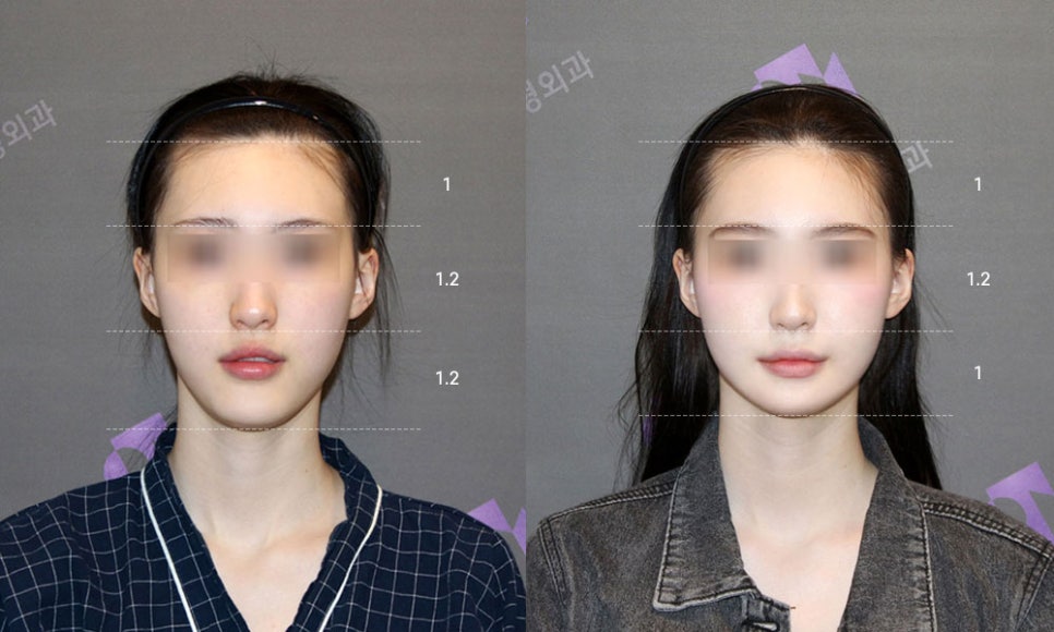 긴턱수술 후 중안면부 얼굴이 길어 보일까요? 관련 이미지 9