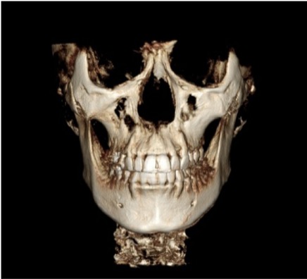 Facial Contouring: How to Avoid an Artificial Face Line image 3