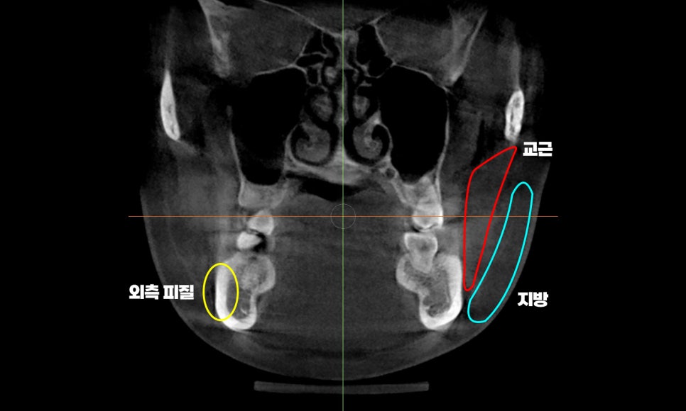 Square Jaw Surgery: What Are a Retracted Jaw and a Protruding Jaw? image 7