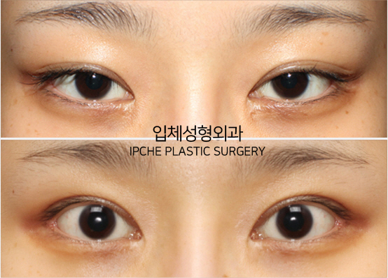 Surgery That Goes Well with Cheekbone Surgery, Part 1: Lateral and Lower Canthoplasty image 7