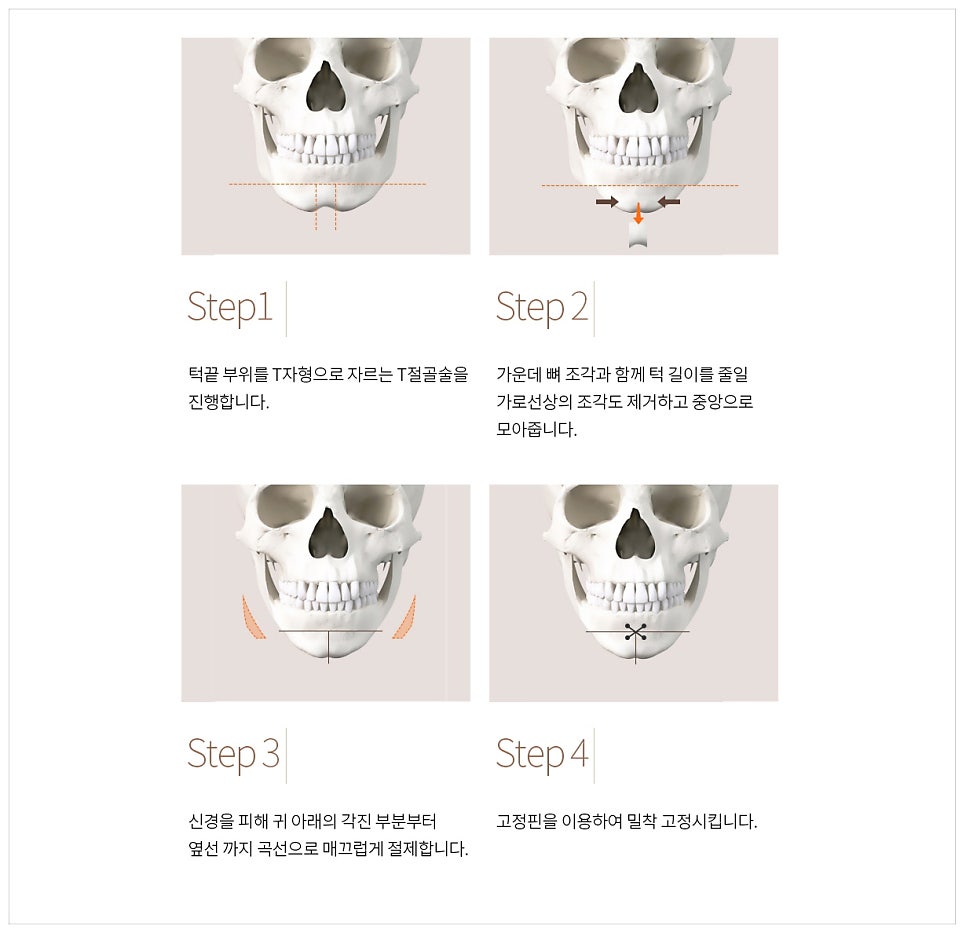 Facial Contouring A to Z: What Is Contouring Surgery? image 7